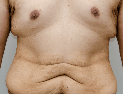 Skin Excision Gynecomastia (Post-Weight Loss Correction)